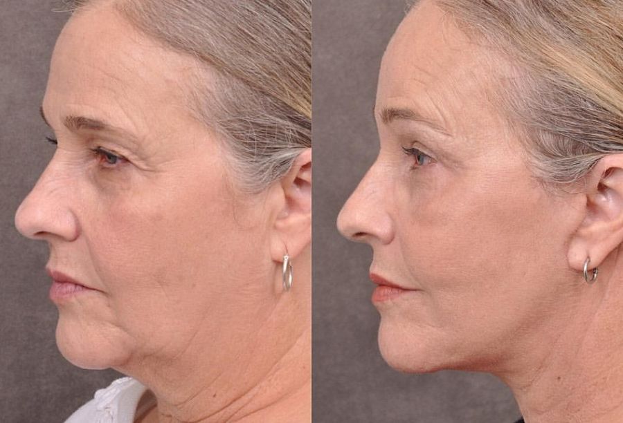 Before / After