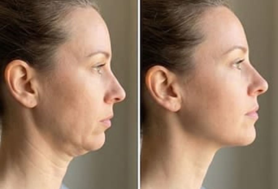 Before / After